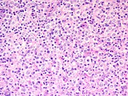 Diffuse large B-cell lymphoma, T-cell/histiocyte rich variant - lymph node - 2.