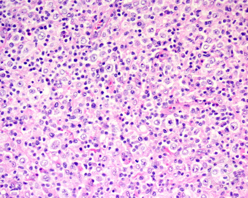 Diffuse large B-cell lymphoma, T-cell/histiocyte rich variant - lymph node - 2.