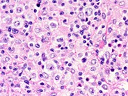 Diffuse large B-cell lymphoma, T-cell/histiocyte rich variant - lymph node - 3.