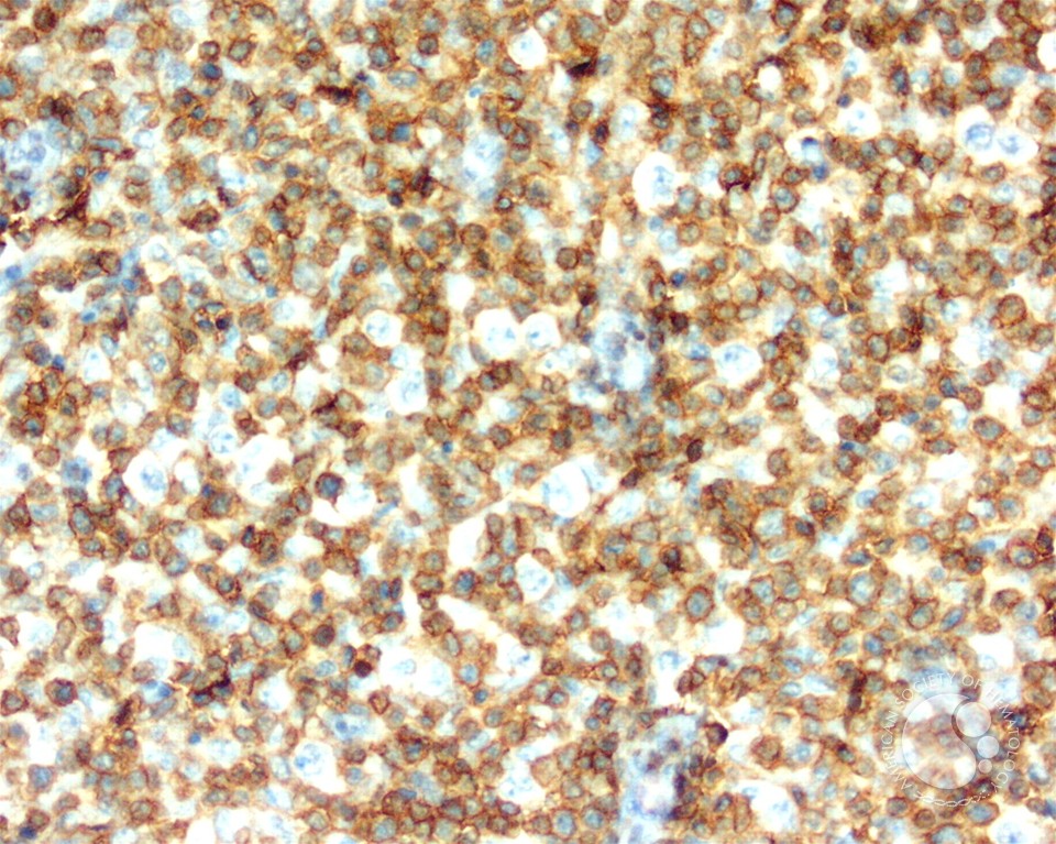 Diffuse large B-cell lymphoma, T-cell/histiocyte rich variant - lymph node - 4.