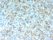Diffuse large B-cell lymphoma, T-cell/histiocyte rich variant - lymph node - 5.