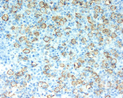 Diffuse large B-cell lymphoma, T-cell/histiocyte rich variant - lymph node - 5.