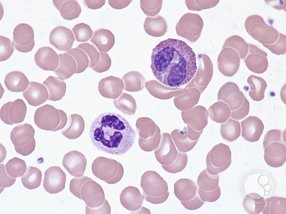 Look-alikes: eosinophil vs. neutrophil - 1.