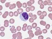 Atypical Lymphocytes With Azurophilic Granules