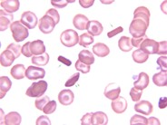 Hemoglobin C crystals - 2.