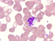 Lymphocyte inclusion in Chediak-Higashi syndrome - 1.