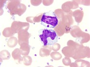 Lymphocyte inclusion in Chediak-Higashi syndrome - 2.