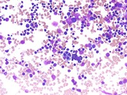 Hematophagocytic lymphohistiocytosis (HLH) in a patient with CLL - 1.