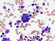 Hematophagocytic lymphohistiocytosis (HLH) in a patient with CLL - 4.
