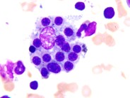 Hematophagocytic lymphohistiocytosis (HLH) in a patient with CLL - 5.