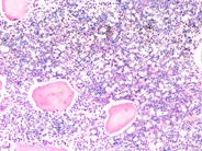 Bone marrow involvement in Niemann Pick disease - 5.