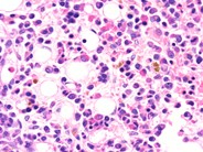 HIV-related plasmacytosis - 3.