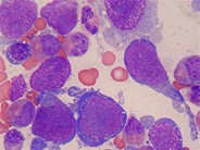 Intravascular lymphoma cells in the bone marrow smears - 1.