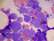 Intravascular lymphoma cells in the bone marrow smears - 2.