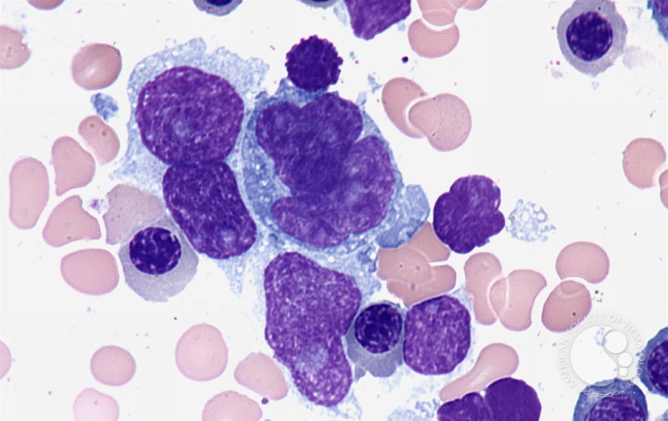 Diffuse large Bcell lymphoma bone marrow aspirate 2.