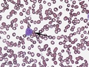 Diffuse large B-cell lymphoma - bone marrow aspirate - 3.