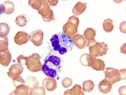 Bone marrow granulomas secondary to Histoplasmosis sepsis - 2.