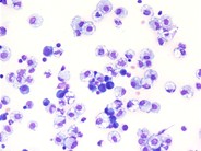 Myeloma cells in ascitic fluid - 1.