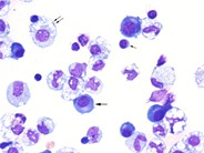 Myeloma cells in ascitic fluid - 2.