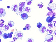 Myeloma cells in ascitic fluid - 3.