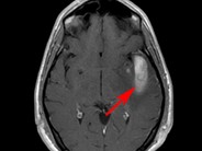 CNS hemorrhage – AML - 1.