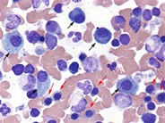 Look-alikes: plasma cells vs. erythroid precursors - 2.