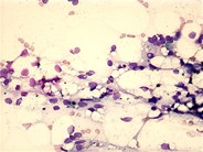 Aplastic anemia - 3.