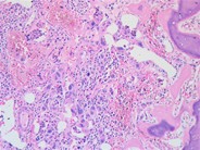 Myelofibrosis associated osteomyelosclerosis - 3.