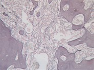 Myelofibrosis associated osteomyelosclerosis - 5.