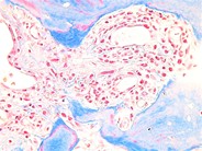 Myelofibrosis associated osteomyelosclerosis - 6.