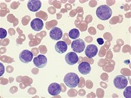 Cytogram- Hyperleukocytosis in AML - 4.