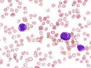 AML with t(15;17)(q22;q21), microgranular variant