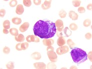 AML with t(15;17)(q22;q21), microgranular variant - 2.