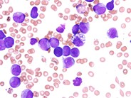 AML with t(15;17)(q22;q21), microgranular variant