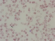 RBC morphology in thalassemia - 1.