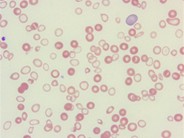 RBC morphology in thalassemia - 3.