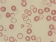 RBC morphology in thalassemia - 4.