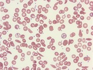 sickle-cell-disease-rbc-morphology-1