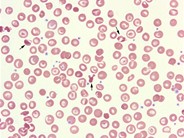 hemoglobin sc disease blood smear