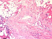 Pulmonary amyloidosis secondary to multiple myeloma - 4.