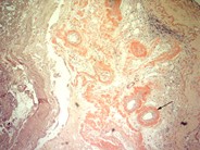 Pulmonary amyloidosis secondary to multiple myeloma - 5.