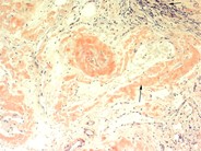 Pulmonary amyloidosis secondary to multiple myeloma - 6.