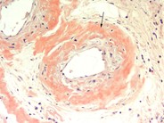 Pulmonary amyloidosis secondary to multiple myeloma - 7.