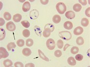 Pappenheimer bodies and basophilic stippling in sickle cell disease - 3.