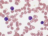 Relapsed pediatric ALL - 1.