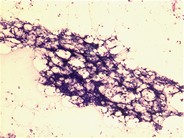 Chemotherapy effect - 1.