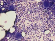 Reactive marrow–adult - 1.