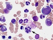 Hypersegmented neutrophil - 1.