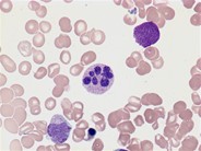 Hypersegmented neutrophil - 2.