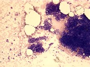 Metastatic medullary carcinoma of the thryoid - 1.